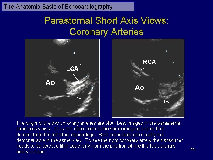 The Anatomic Basis of Echocardiography Parasternal Short Axis Views: Coronary Arteries RCA LCA Ao