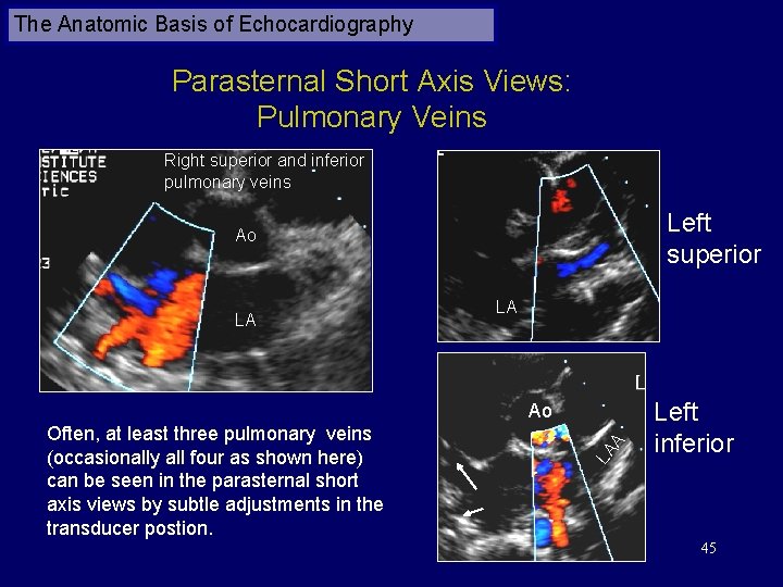The Anatomic Basis of Echocardiography Parasternal Short Axis Views: Pulmonary Veins Right superior and