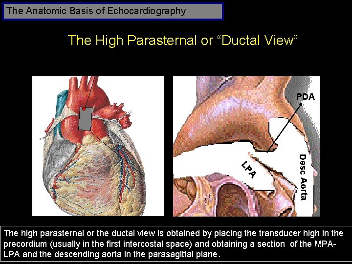 The Anatomic Basis of Echocardiography The High Parasternal or “Ductal View” PDA Asc Aorta
