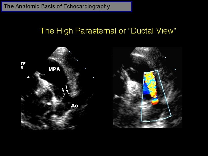 The Anatomic Basis of Echocardiography The High Parasternal or “Ductal View” MPA Ao 48