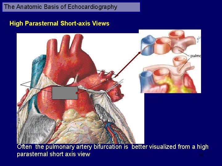 The Anatomic Basis of Echocardiography High Parasternal Short-axis Views Often the pulmonary artery bifurcation