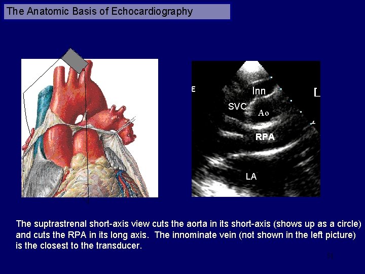 The Anatomic Basis of Echocardiography Inn SVC Ao RPA LA The suptrastrenal short-axis view