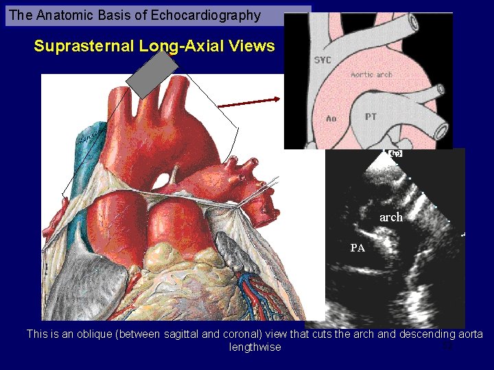 The Anatomic Basis of Echocardiography Suprasternal Long-Axial Views arch PA This is an oblique