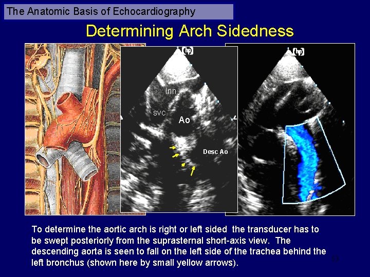 The Anatomic Basis of Echocardiography Determining Arch Sidedness Inn SVC Ao Desc Ao To
