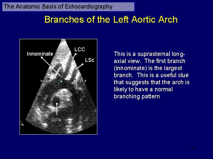 The Anatomic Basis of Echocardiography Branches of the Left Aortic Arch Innominate LCC Asc