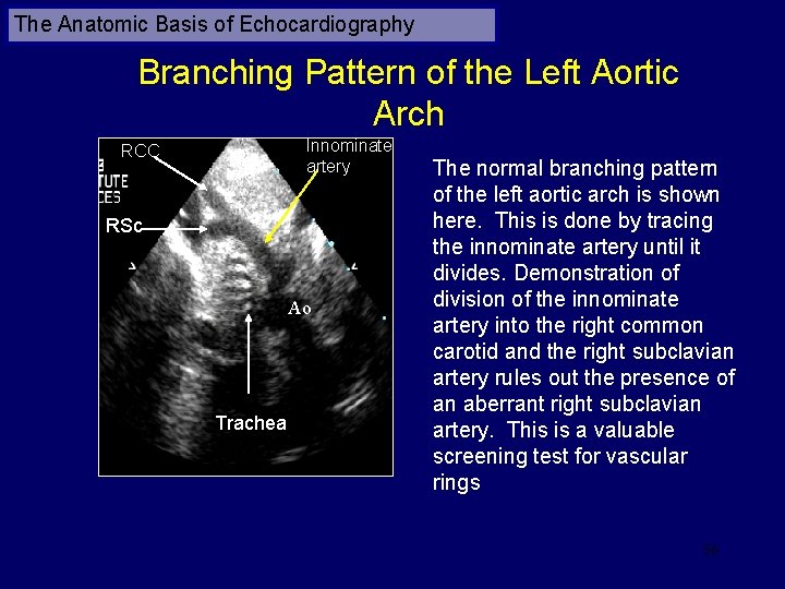 The Anatomic Basis of Echocardiography Branching Pattern of the Left Aortic Arch Innominate artery