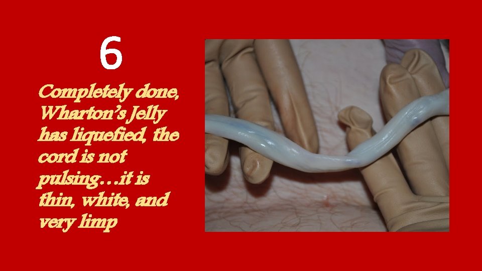 6 Completely done, Wharton’s Jelly has liquefied, the cord is not pulsing…it is thin,