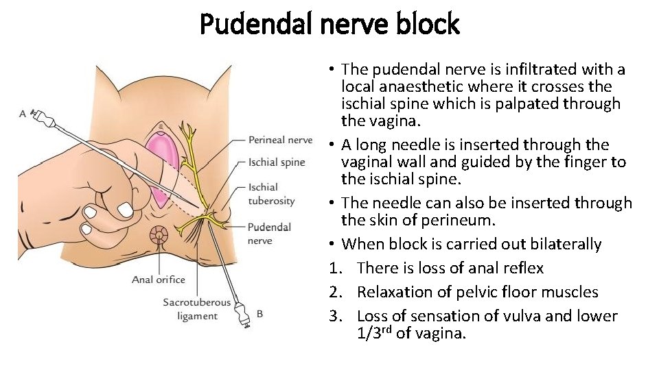 Pudendal nerve block • The pudendal nerve is infiltrated with a local anaesthetic where