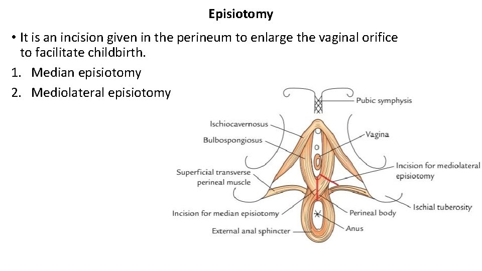 Episiotomy • It is an incision given in the perineum to enlarge the vaginal