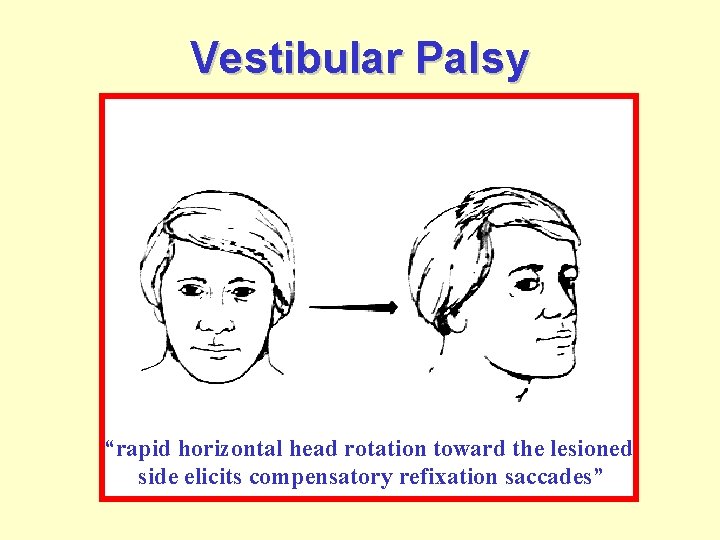 Vestibular Palsy “rapid horizontal head rotation toward the lesioned side elicits compensatory refixation saccades”