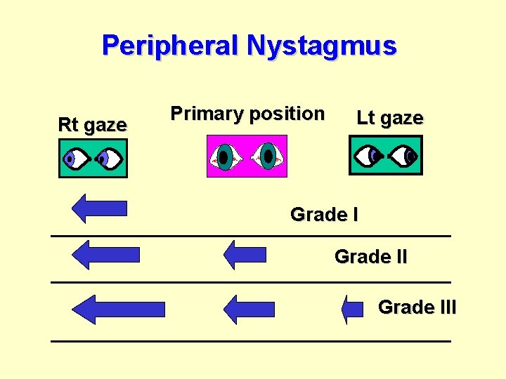 Peripheral Nystagmus Rt gaze Primary position Lt gaze Grade III 