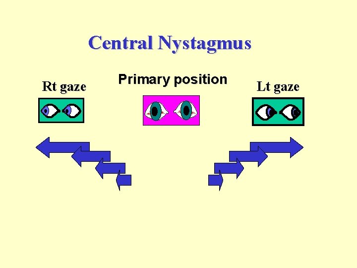 Central Nystagmus Rt gaze Primary position Lt gaze 