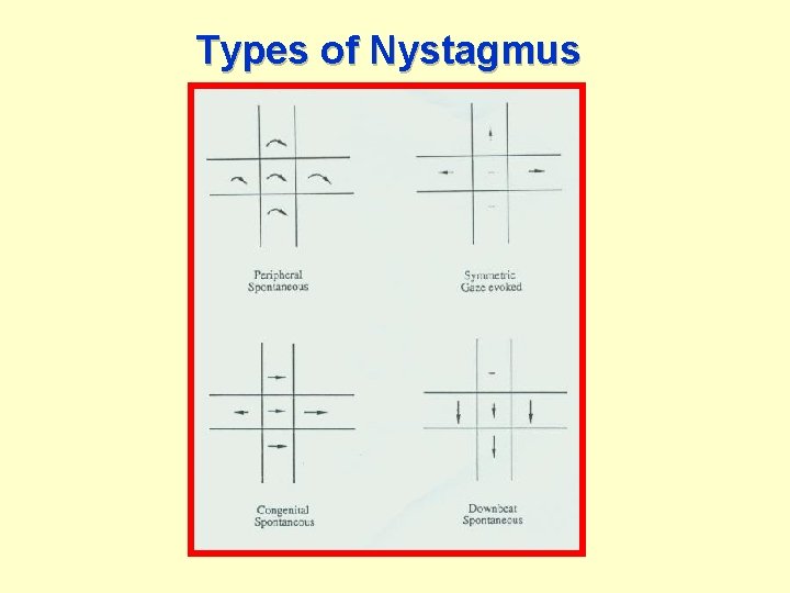 Types of Nystagmus 