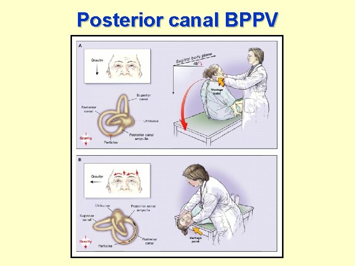 Posterior canal BPPV 