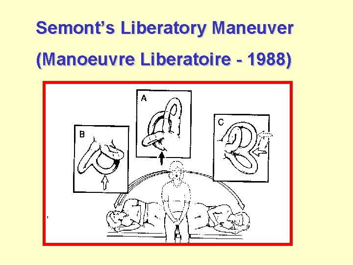 Semont’s Liberatory Maneuver (Manoeuvre Liberatoire - 1988) 