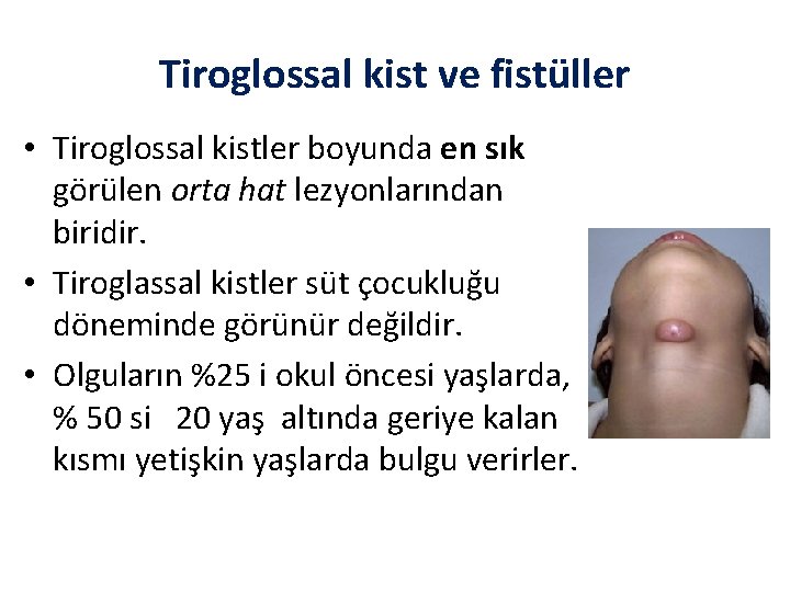 Tiroglossal kist ve fistüller • Tiroglossal kistler boyunda en sık görülen orta hat lezyonlarından