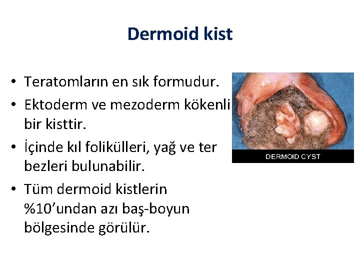 Dermoid kist • Teratomların en sık formudur. • Ektoderm ve mezoderm kökenli bir kisttir.