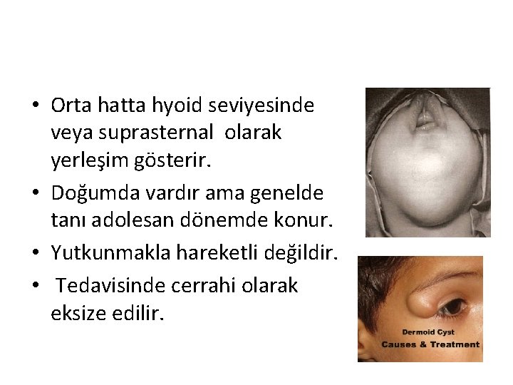  • Orta hatta hyoid seviyesinde veya suprasternal olarak yerleşim gösterir. • Doğumda vardır