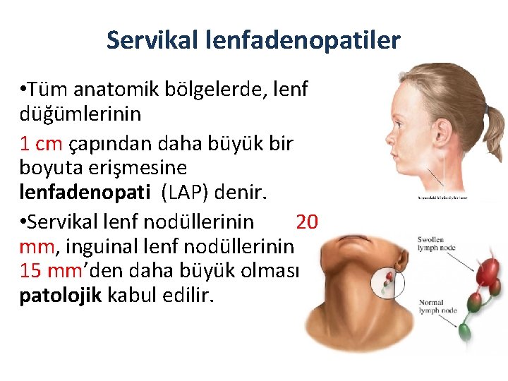 Servikal lenfadenopatiler • Tüm anatomik bölgelerde, lenf düğümlerinin 1 cm çapından daha büyük bir