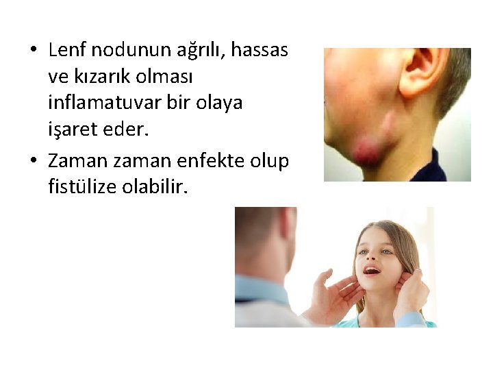  • Lenf nodunun ağrılı, hassas ve kızarık olması inflamatuvar bir olaya işaret eder.