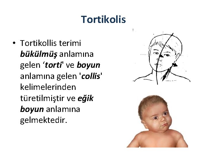 Tortikolis • Tortikollis terimi bükülmüş anlamına gelen ‘torti' ve boyun anlamına gelen 'collis' kelimelerinden