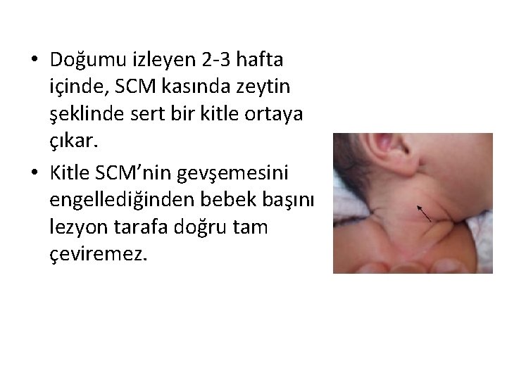  • Doğumu izleyen 2 -3 hafta içinde, SCM kasında zeytin şeklinde sert bir