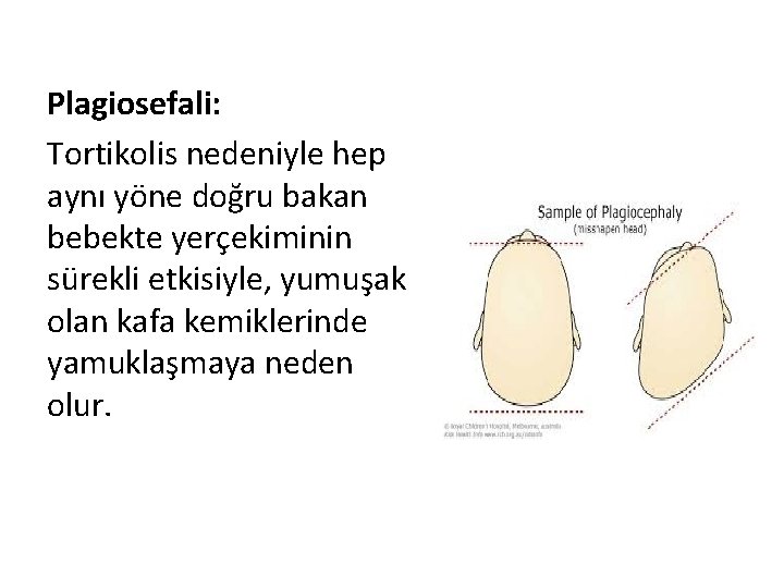 Plagiosefali: Tortikolis nedeniyle hep aynı yöne doğru bakan bebekte yerçekiminin sürekli etkisiyle, yumuşak olan