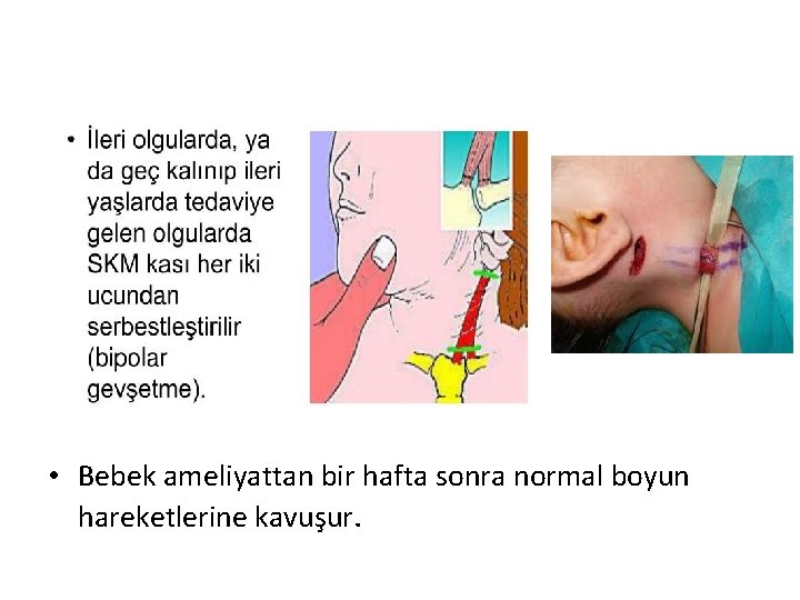  • Bebek ameliyattan bir hafta sonra normal boyun hareketlerine kavuşur. 