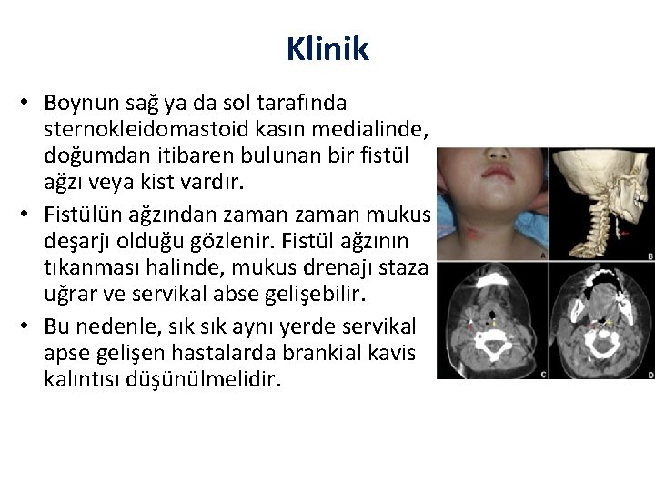 Klinik • Boynun sağ ya da sol tarafında sternokleidomastoid kasın medialinde, doğumdan itibaren bulunan