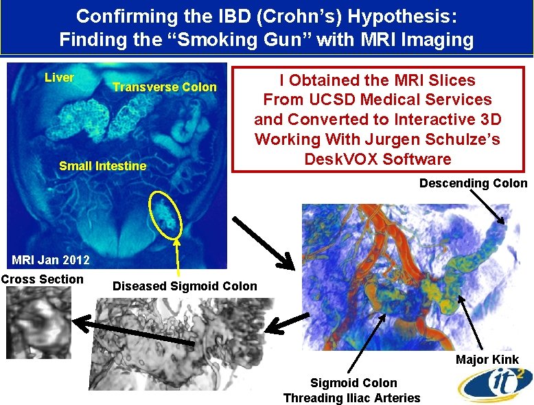 Confirming the IBD (Crohn’s) Hypothesis: Finding the “Smoking Gun” with MRI Imaging Liver Transverse