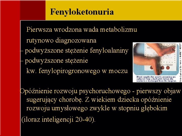 Fenyloketonuria Pierwsza wrodzona wada metabolizmu rutynowo diagnozowana – podwyższone stężenie fenyloalaniny – podwyższone stężenie