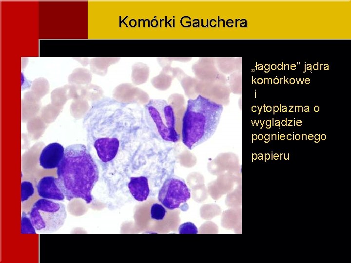 Komórki Gauchera „łagodne” jądra komórkowe i cytoplazma o wyglądzie pogniecionego papieru 