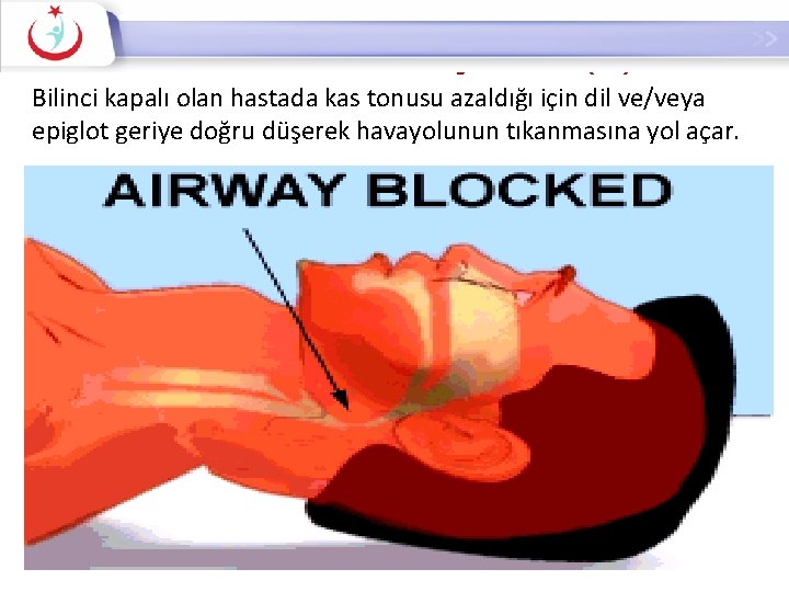 Hava Yolunun Açılması (A) Bilinci kapalı olan hastada kas tonusu azaldığı için dil ve/veya