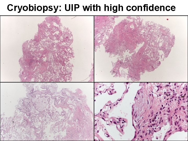 Cryobiopsy: UIP with high confidence 