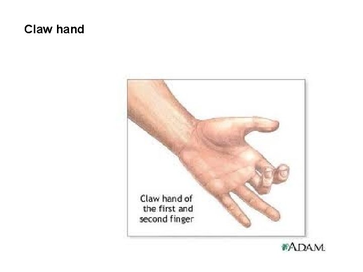 Claw hand 