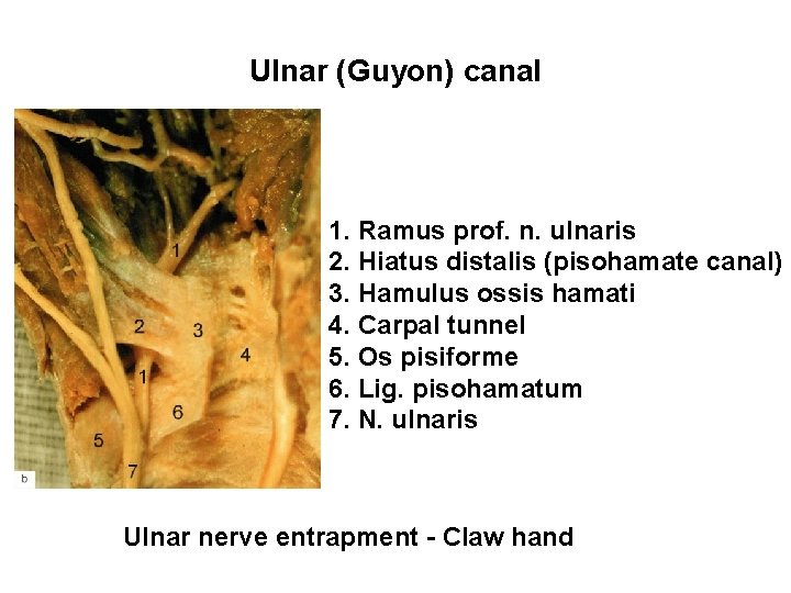 Ulnar (Guyon) canal 1. Ramus prof. n. ulnaris 2. Hiatus distalis (pisohamate canal) 3.