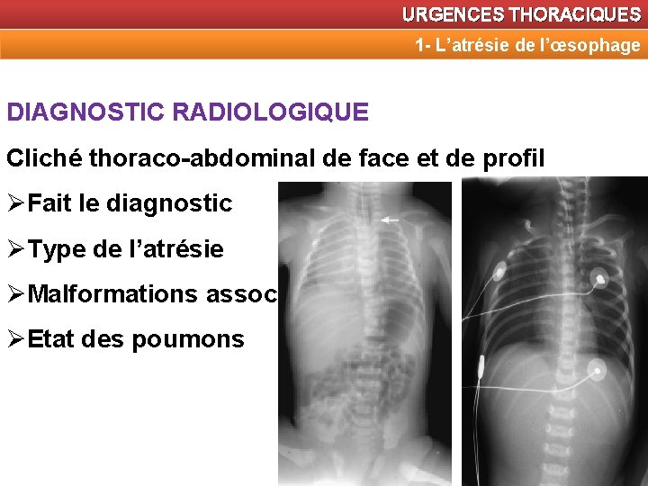 URGENCES THORACIQUES 1 - L’atrésie de l’œsophage DIAGNOSTIC RADIOLOGIQUE Cliché thoraco-abdominal de face et