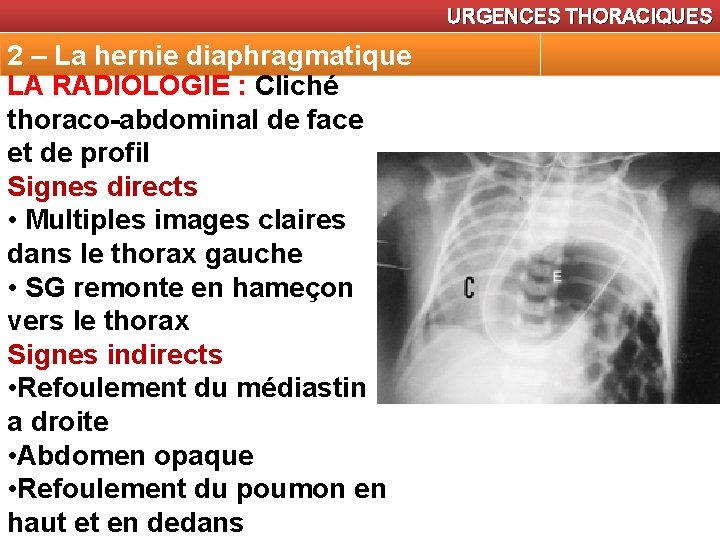 URGENCES THORACIQUES 2 – La hernie diaphragmatique LA RADIOLOGIE : Cliché thoraco-abdominal de face