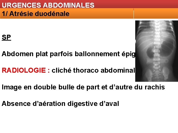 URGENCES ABDOMINALES 1/ Atrésie duodénale SP Abdomen plat parfois ballonnement épigastrique RADIOLOGIE : cliché