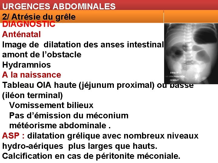 URGENCES ABDOMINALES 2/ Atrésie du grêle DIAGNOSTIC Anténatal Image de dilatation des anses intestinales