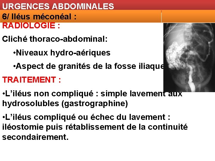 URGENCES ABDOMINALES 6/ Iléus méconéal : RADIOLOGIE : Cliché thoraco-abdominal: • Niveaux hydro-aériques •