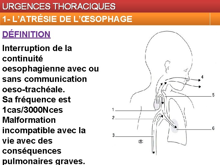 URGENCES THORACIQUES 1 - L’ATRÉSIE DE L’ŒSOPHAGE DÉFINITION Interruption de la continuité oesophagienne avec