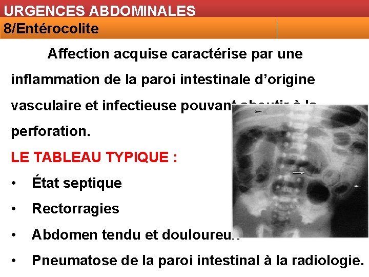 URGENCES ABDOMINALES 8/Entérocolite Affection acquise caractérise par une inflammation de la paroi intestinale d’origine