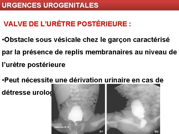 URGENCES UROGENITALES VALVE DE L’URÈTRE POSTÉRIEURE : • Obstacle sous vésicale chez le garçon