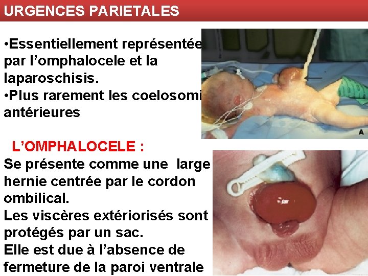 URGENCES PARIETALES • Essentiellement représentées par l’omphalocele et la laparoschisis. • Plus rarement les
