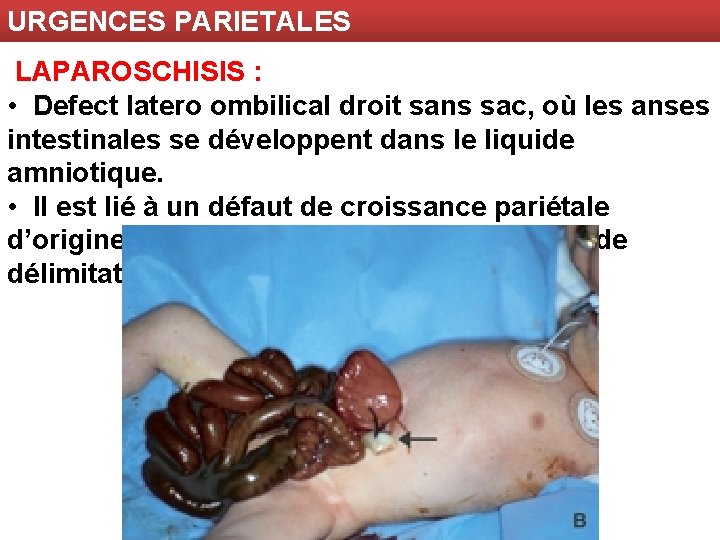 URGENCES PARIETALES LAPAROSCHISIS : • Defect latero ombilical droit sans sac, où les anses