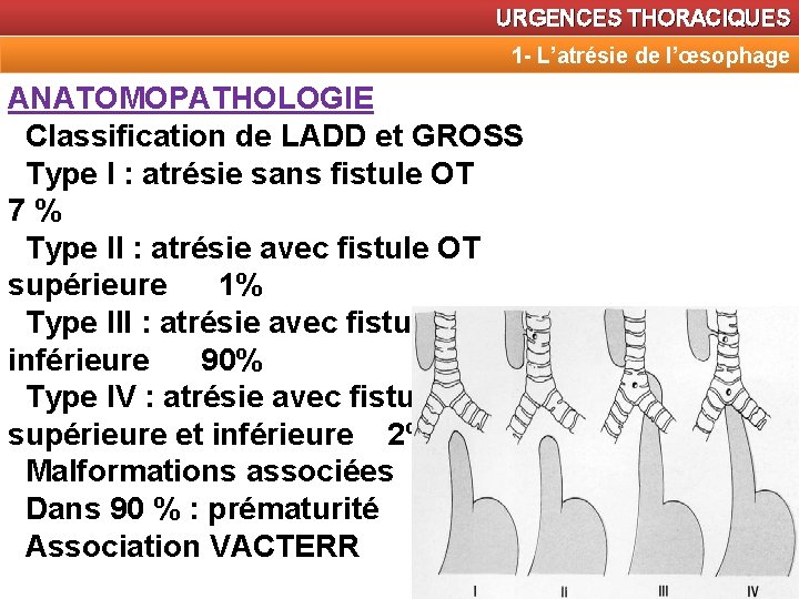 URGENCES THORACIQUES 1 - L’atrésie de l’œsophage ANATOMOPATHOLOGIE Classification de LADD et GROSS Type