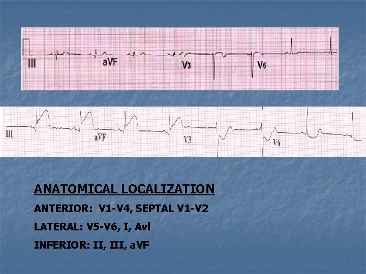 ANATOMICAL LOCALIZATION ANTERIOR: V 1 -V 4, SEPTAL V 1 -V 2 LATERAL: V