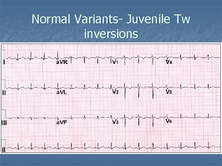 Normal Variants- Juvenile Tw inversions 
