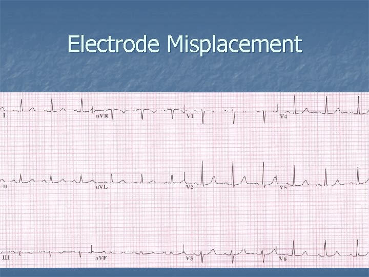 Electrode Misplacement 